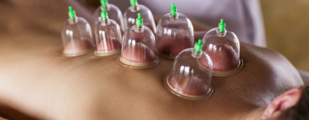 Cupping Therapy: A Holistic Approach to Wellness