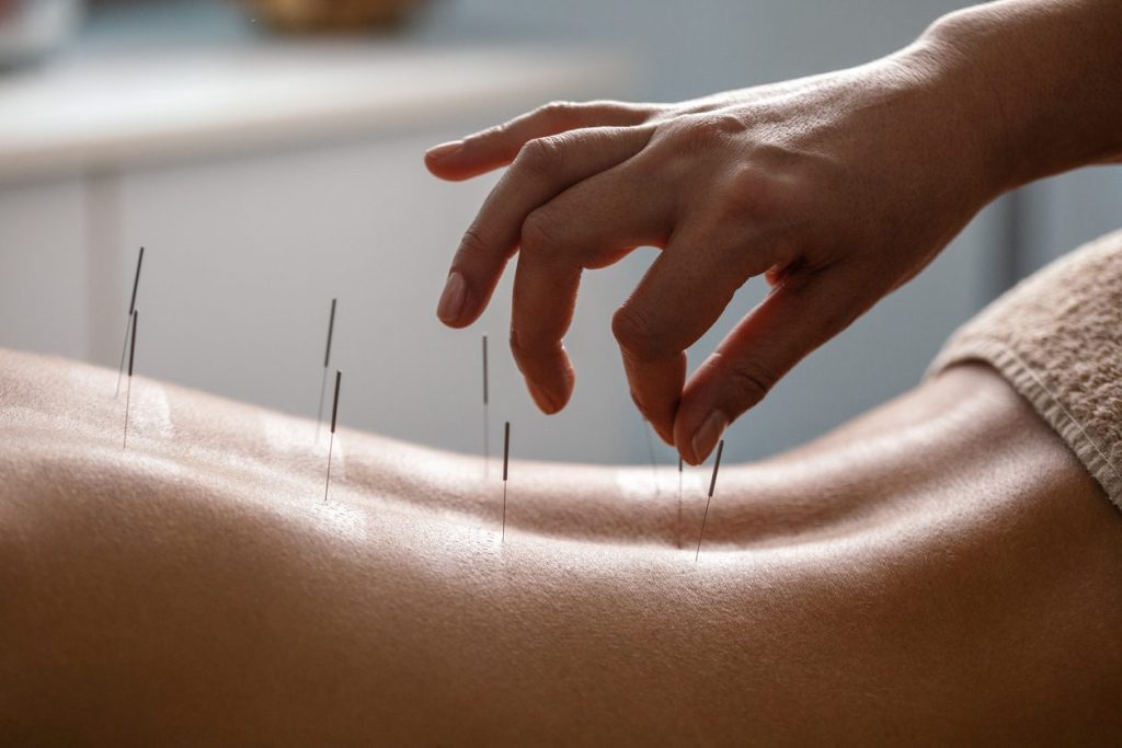 Exploring Acupuncture in the UAE: A Holistic Approach to Wellness